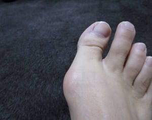 痛風は30年間で4倍に！女性の“オッサン化”に思わぬ危険