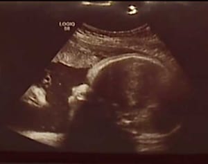 胎児エコー写真に写っていた驚きのモノとは？