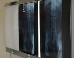 「関西女性は骨折しやすい」を検証…原因は腸内細菌にあり！