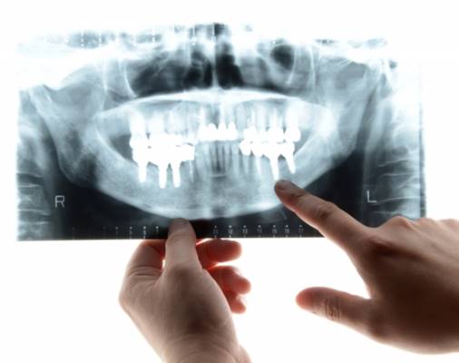 なぜインプラント治療をゴリ推しする歯科医師はダメなのか