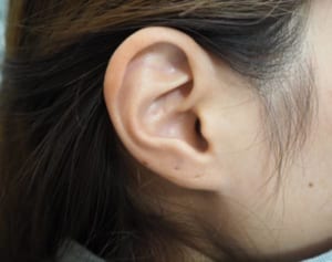 石原慎太郎も実証!?“耳たぶのシワ”は脳梗塞のサインかも