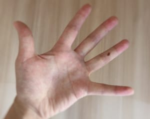 手の甲のホクロは腸の不調のサイン…お血でわかる病気のサイン