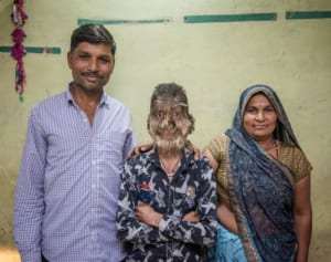 発毛剤入り胃薬を飲んだ赤ちゃん「狼男症候群」に