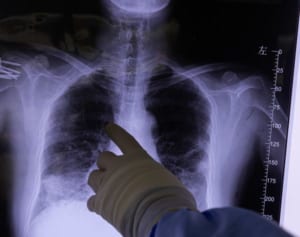 「高熱なのに汗をかかない」コロナ発症者が明かす意外な症状