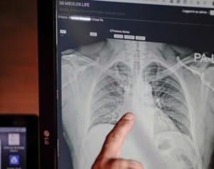 コロナ症状は10日目前後に注意　基礎疾患なしで両肺重篤化も