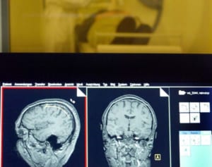 脳炎から認知症になる可能性も　専門家危惧するコロナ後遺症