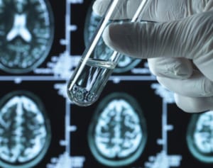 認知症薬「アデュカヌマブ」既存薬との“画期的な”違い