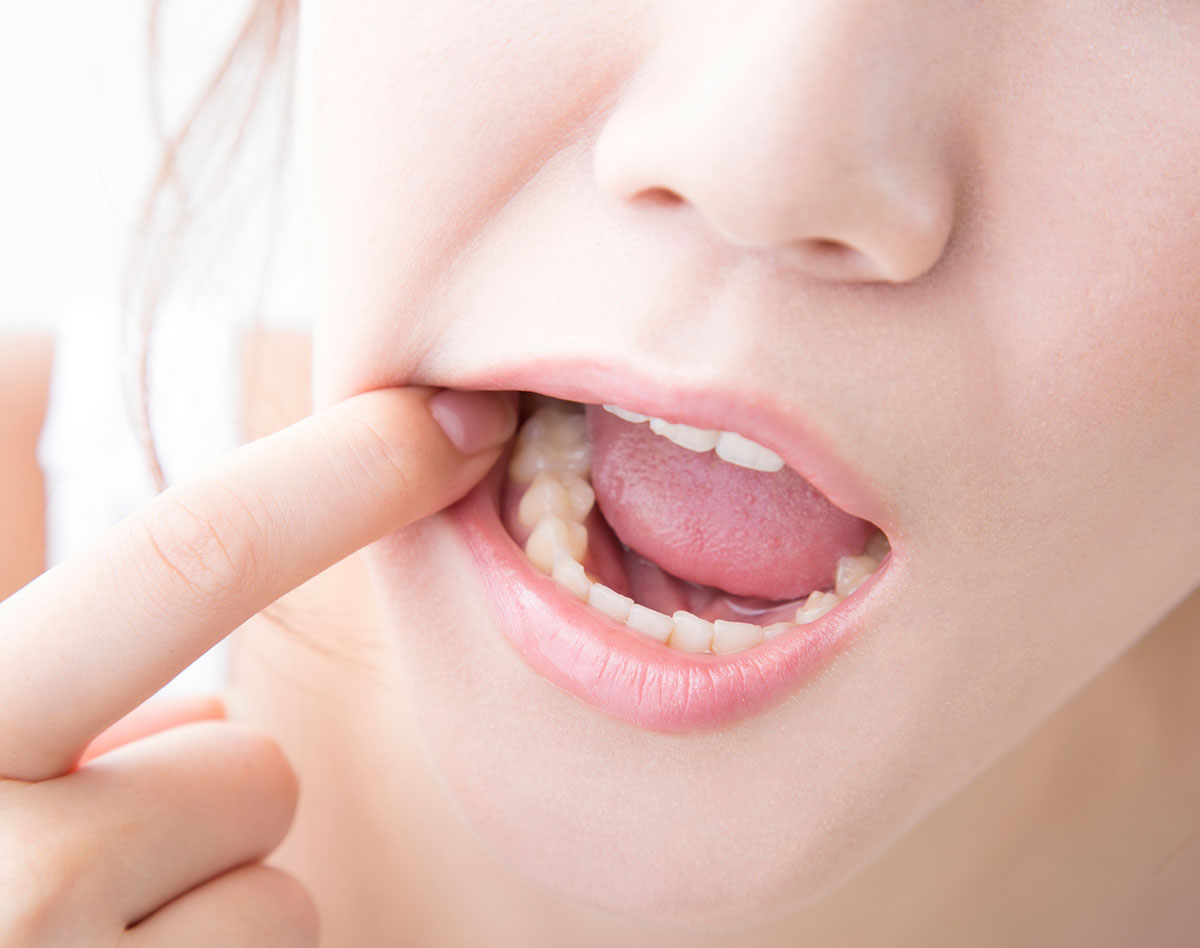 医師が解説「無痛の口内炎がじつは口腔がんの初期症状であることも」