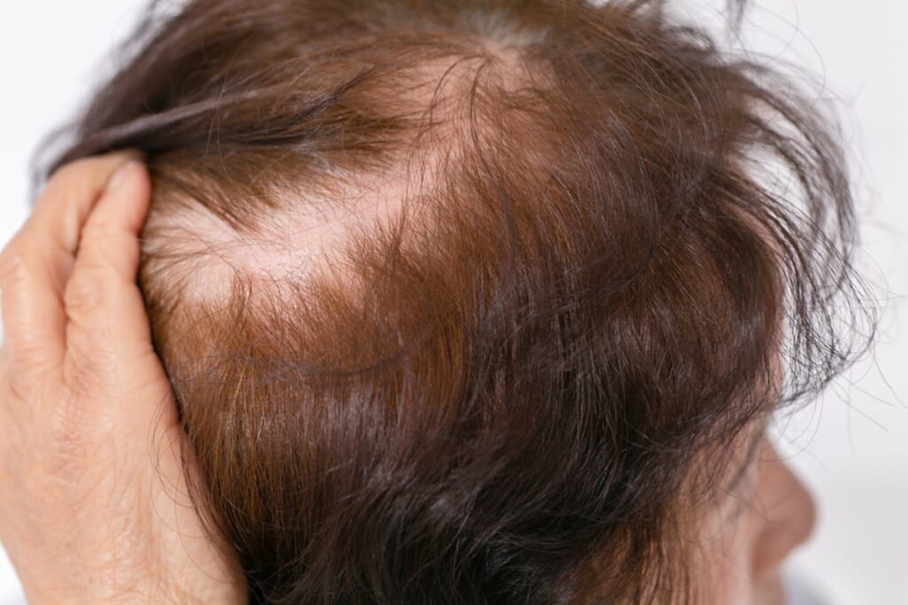 “抜ける”3大原因は「貧血」「血行不良」「ホルモン減少」めまい、腰痛、耳鳴り…不調でわかる「薄毛対策」