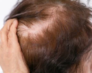 “抜ける”3大原因は「貧血」｢血行不良｣｢ホルモン減少｣めまい、腰痛、耳鳴り…不調でわかる「薄毛対策」