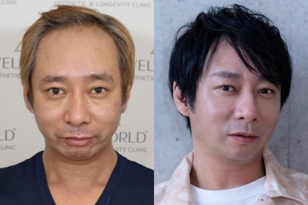 《「ハゲ」「キモい」と言われ…》いしだ壱成　薄毛で芸能界引退、うつ・離婚も…植毛で取り戻した自信「ここからが第二の人生」