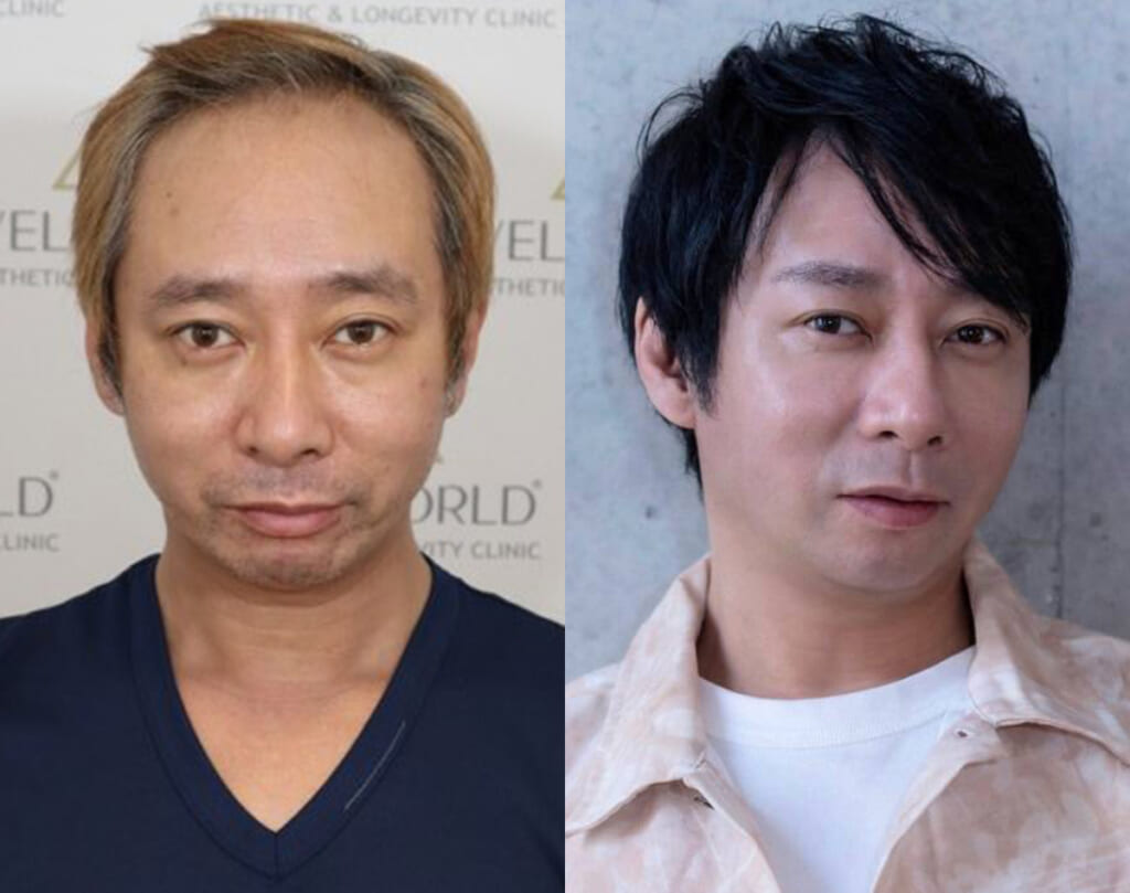 《「ハゲ」「キモい」と言われ…》いしだ壱成　薄毛で芸能界引退、うつ・離婚も…植毛で取り戻した自信「ここからが第二の人生」