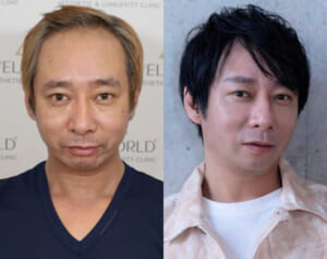 《「ハゲ」「キモい」と言われ…》いしだ壱成　薄毛で芸能界引退、うつ・離婚も…植毛で取り戻した自信「ここからが第二の人生」