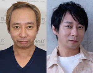 《「ハゲ」「キモい」と言われ…》いしだ壱成　薄毛で芸能界引退、うつ・離婚も…植毛で取り戻した自信「ここからが第二の人生」